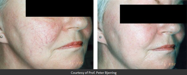 Before and After Two Treatments
