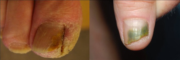 Different appearances of onychomycosis